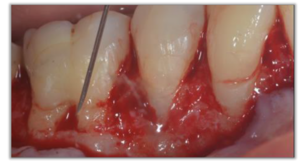 Mandibular Gingival Recession with Furcation Involvement Treated with Cross-linked Hyaluronic Acid