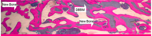 Histology DBBM + xHyA at 2 months