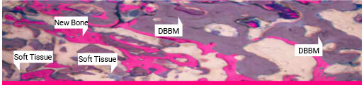 Histology DBBM at 2 months