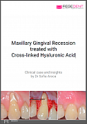 Maxillary Gingival Recession treated with Cross-linked Hyaluronic Acid